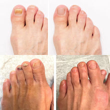 Afbeelding in Gallery-weergave laden, PureNail - Gepatenteerde nagelschimmeltherapie – voor gezonde nagels binnen 4 weken
